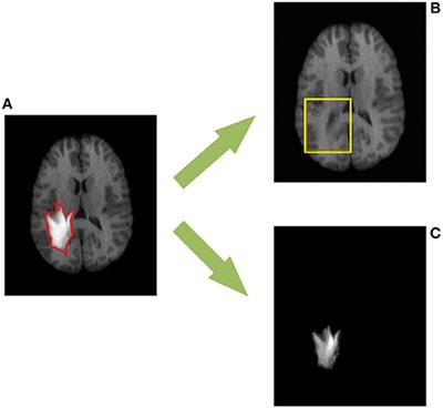 Low-Rank Based Image Analyses for Pathological MR Image Segmentation and Recovery